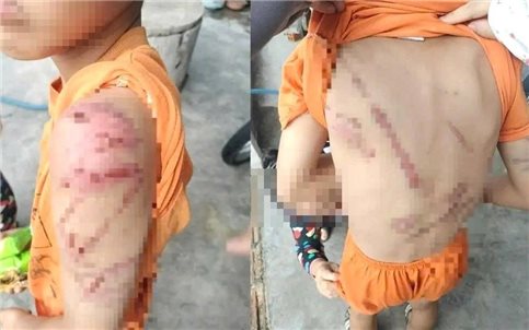 Diễn biến mới vụ bé trai chi chít vết thương ở Đắk Lắk